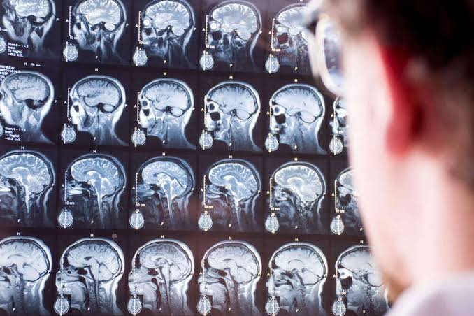 Average Cost of Brain Injury Cases Explained