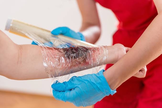 Burn Injury