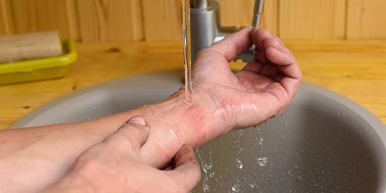 Common Mistakes to Avoid in Burn Injury