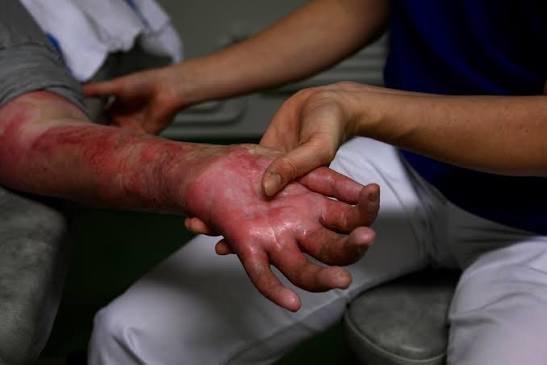 How Does Burn Injury Work