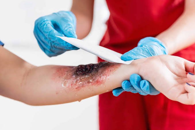 Step-by-Step Process for Burn Injury